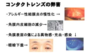 レーシックは安全？手術1000件の眼科医が教える、自分にとって最適な手術の受け方の画像2