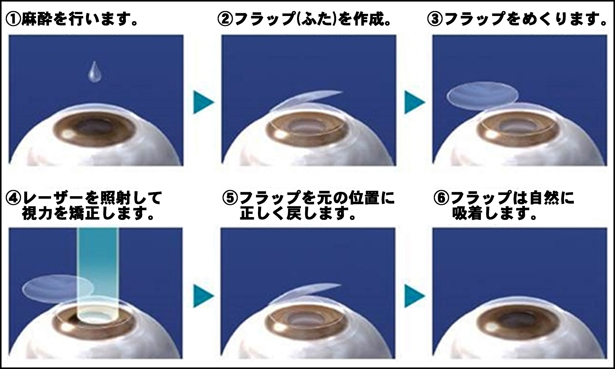 レーシックは安全？手術1000件の眼科医が教える、自分にとって最適な手術の受け方の画像3