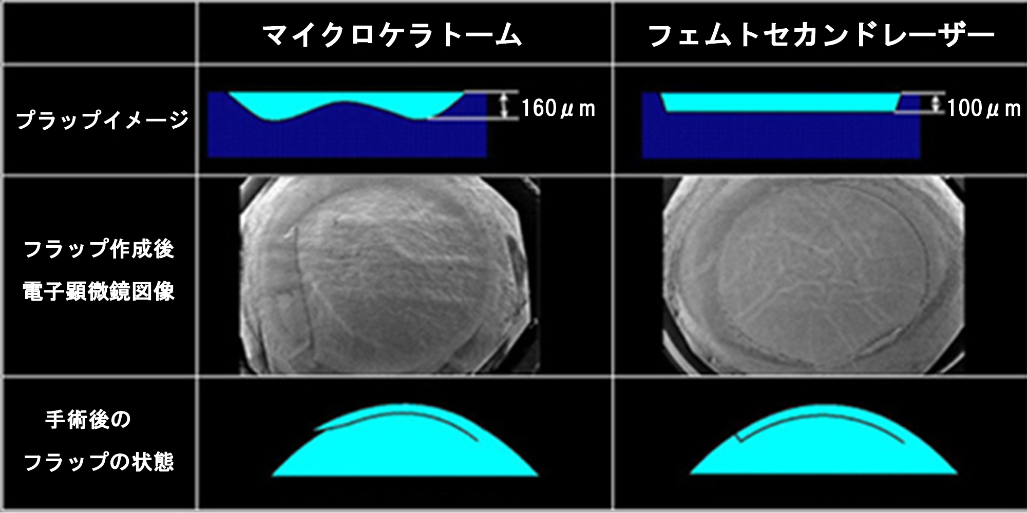 レーシックは安全？手術1000件の眼科医が教える、自分にとって最適な手術の受け方の画像5