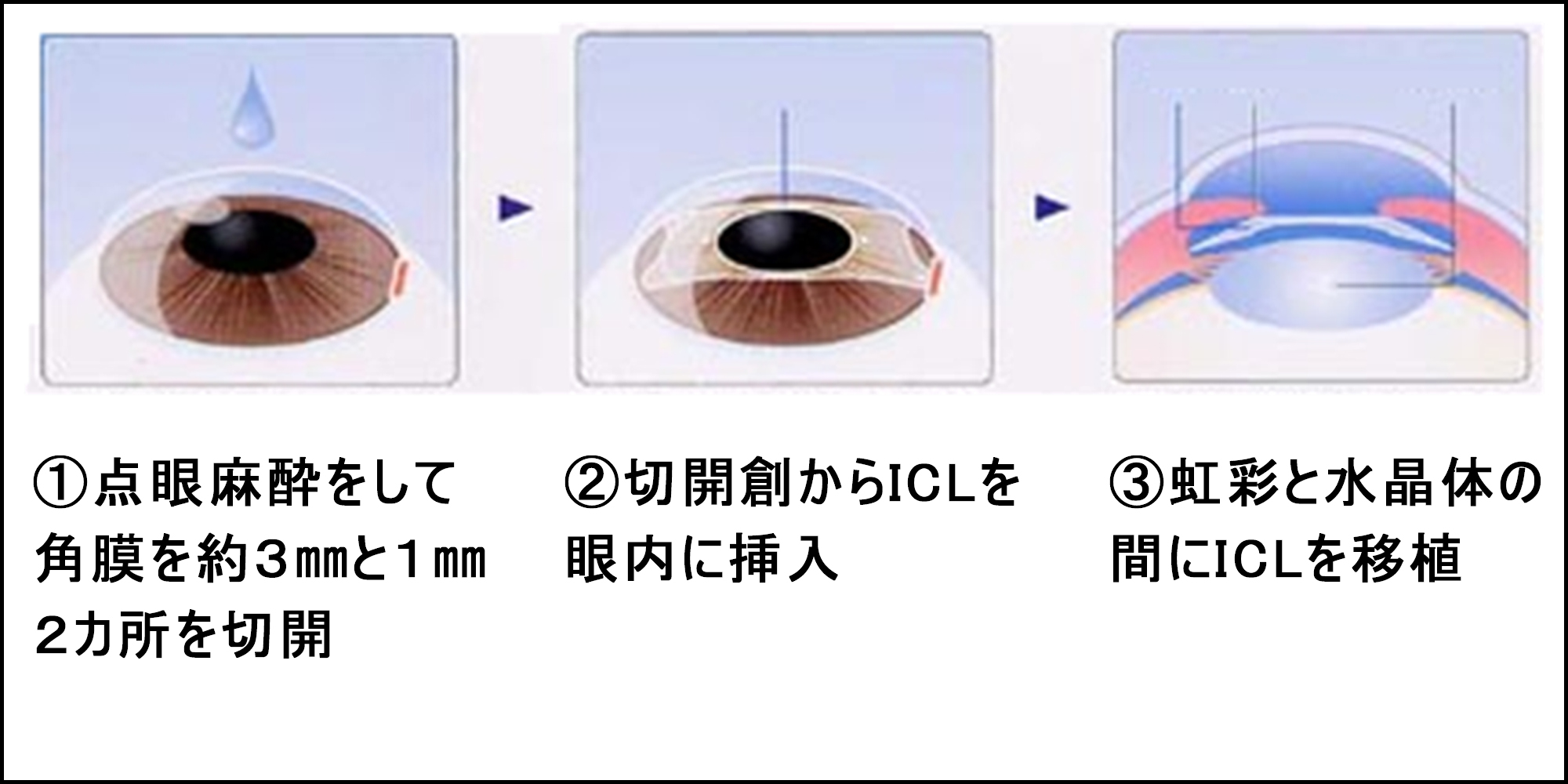 Icl レーシック