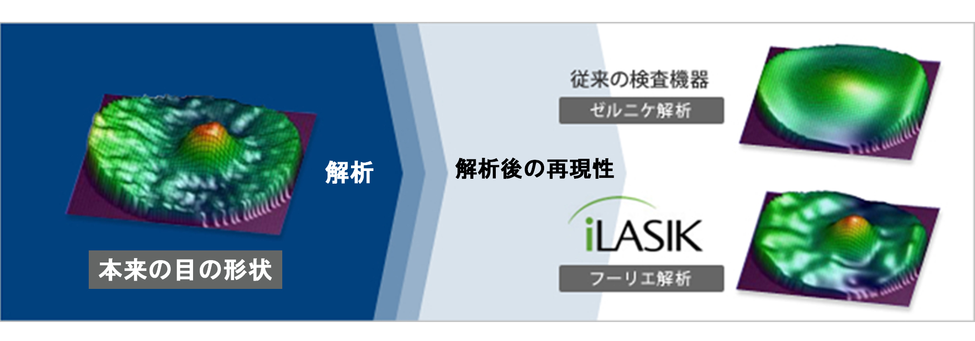 レーシックは安全？手術1000件の眼科医が教える、自分にとって最適な手術の受け方の画像7