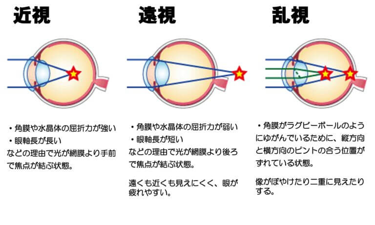 【眼科医に聞く】レーシックは危ない？将来のリスクはどうなの？ | 1万年堂ライフ