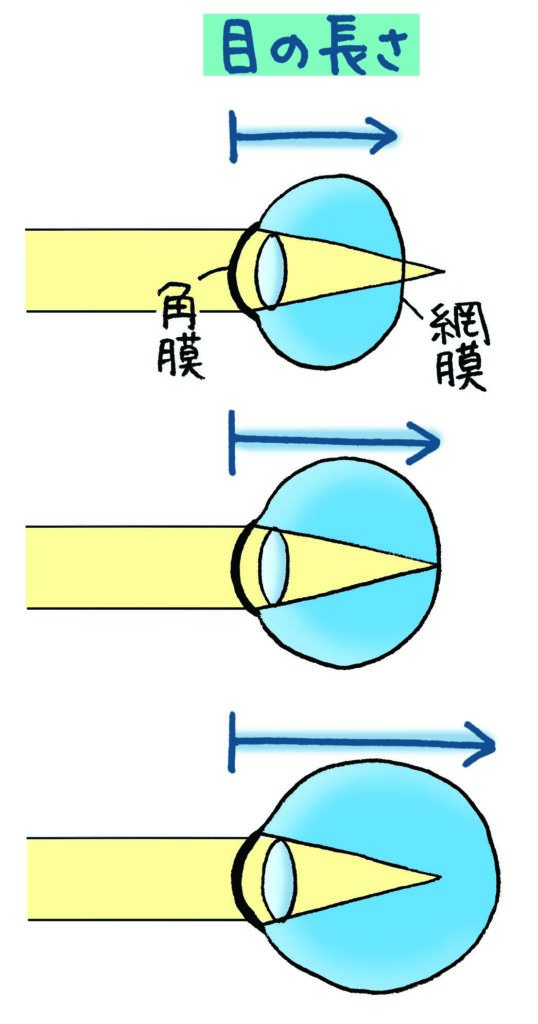 【教えてドクター】親が近眼だと子どもに遺伝する？スマホを見せても大丈夫？の画像4