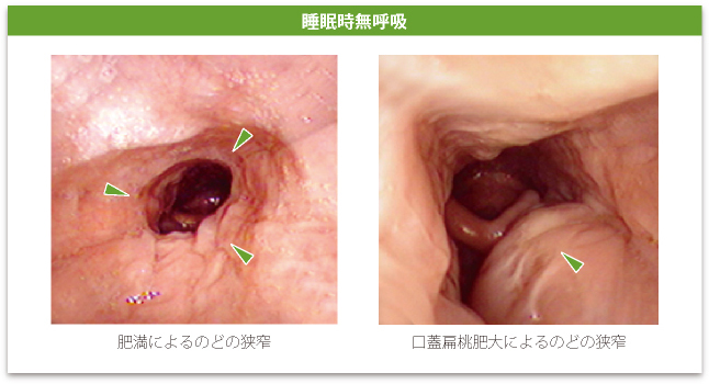 睡眠時無呼吸症候群といびきの違いは？危険度を日中の眠気でセルフチェックの画像1